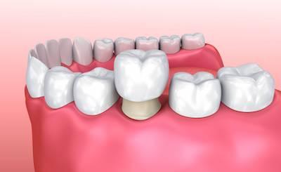A dental crown is placed over an existing tooth