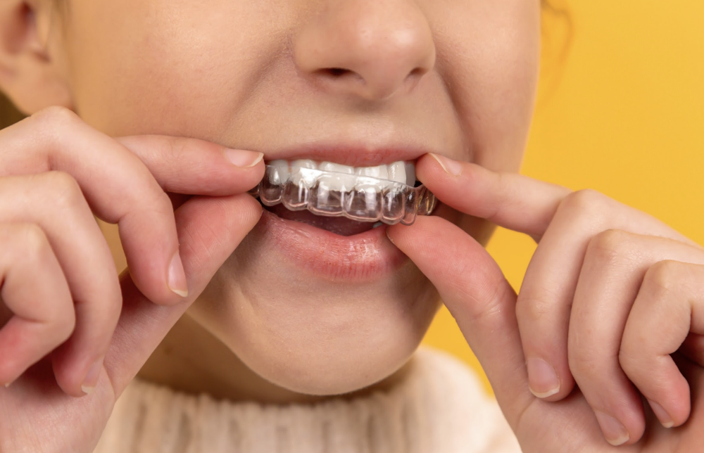 invisalign for kids spring branch | kid putting in aligner