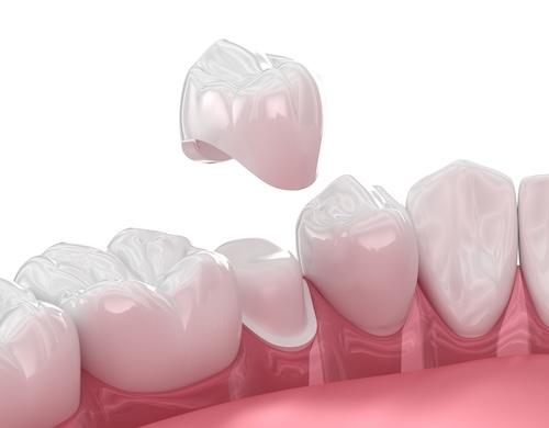 dental crown on row of teeth | dental crowns spring branch