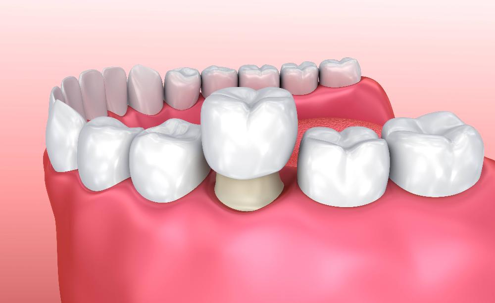 close up of dental crown on tooth | dental crowns spring branch