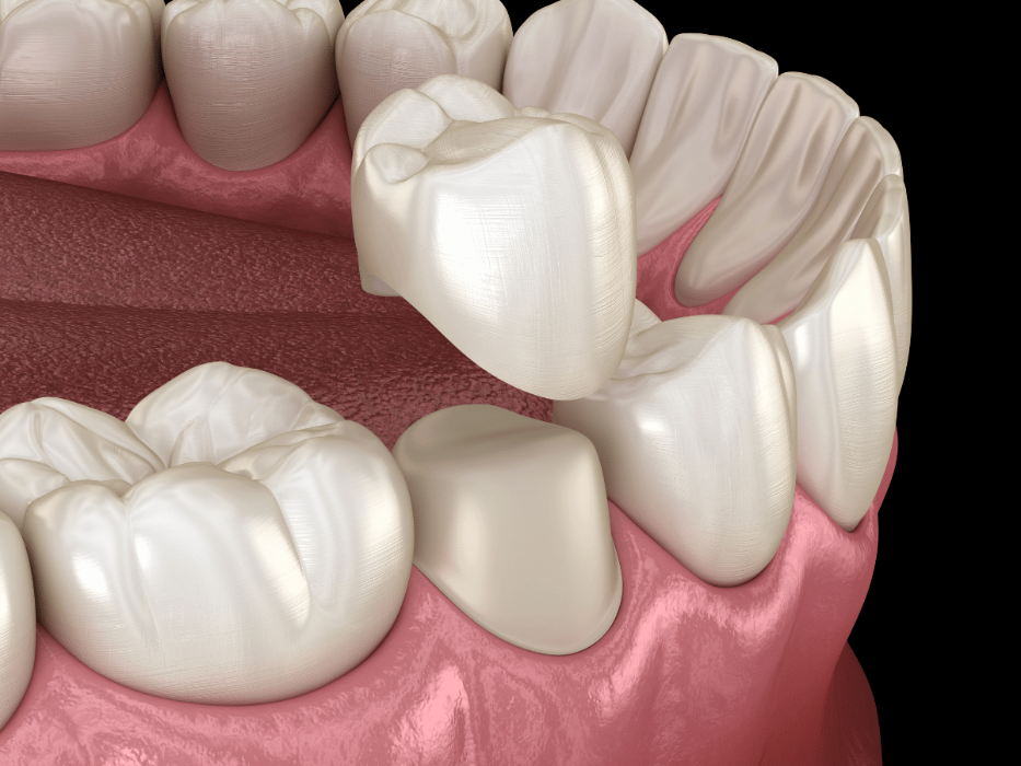 dental crown spring branch