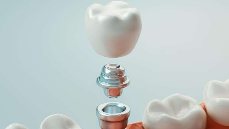 dental implants spring branch
