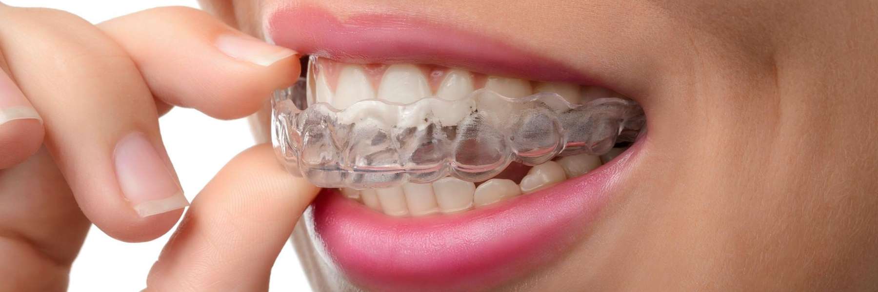 patient putting in clear braces