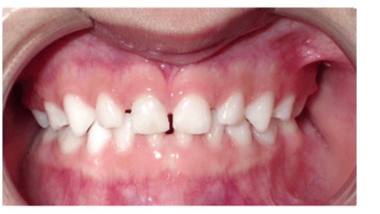 aligned smile after orthodontic treatment | pediatric dentist spring branch tx