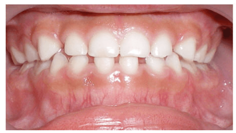 even and aligned smile after treatment | braces for kids