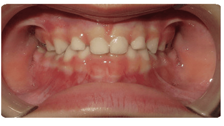 properly aligned smile after dental treatment | braces for children