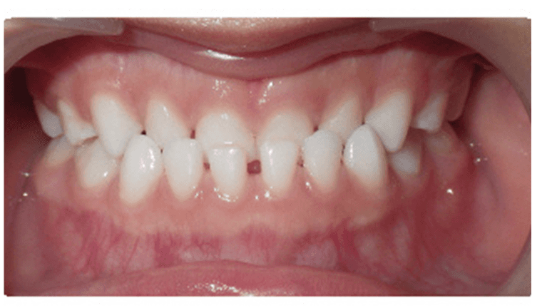 underbite before dental treatment | braces for children