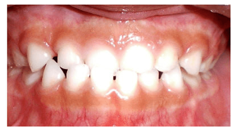 misaligned teeth before dental treatment | pediatric dentist spring branch tx