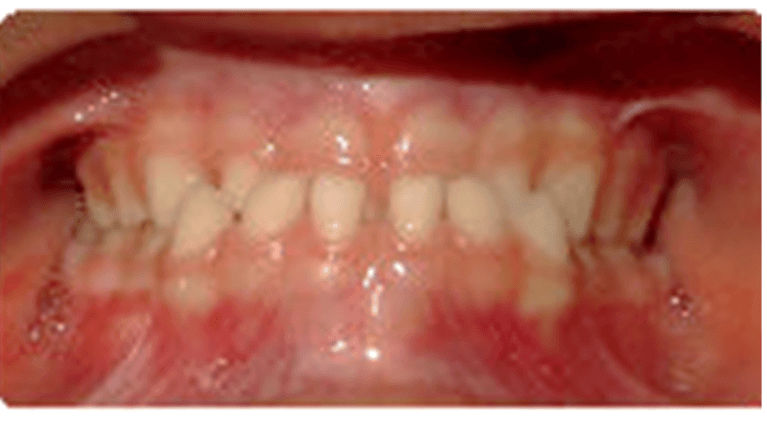 misaligned teeth before orthodontic treatment | pediatric dentist spring branch