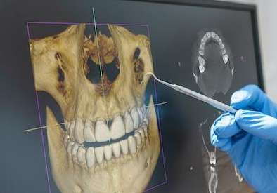 dental implants spring branch | 3-D Cone Beam Imaging (CBCT)