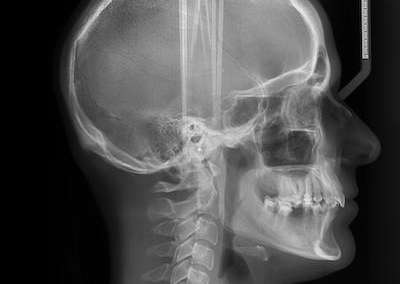 spring branch dentist | ceph x-rays