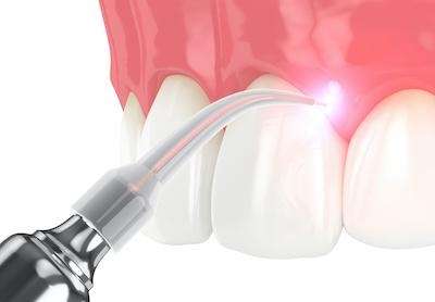 spring branch dentist | laser dentistry