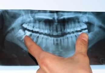 spring branch dentist | panoramic x-rays